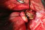 Feeding artery ligated and partially divided