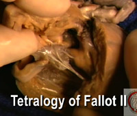 Video 5 - Tetralogy of Fallot II