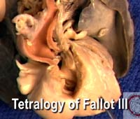 Video 6 - Tetralogy of Fallot III
