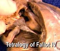Video 7 - Tetralogy of Fallot IV