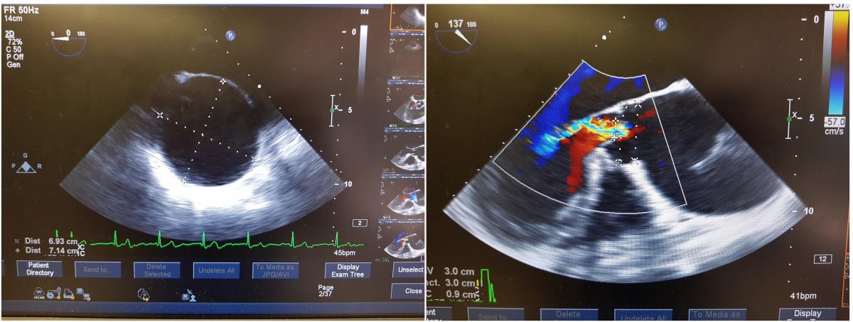 Replacement of the Ascending Aorta With Aortic Root Remodeling Without ...