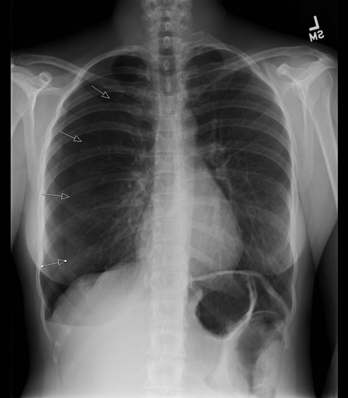 spontaneous pneumothorax