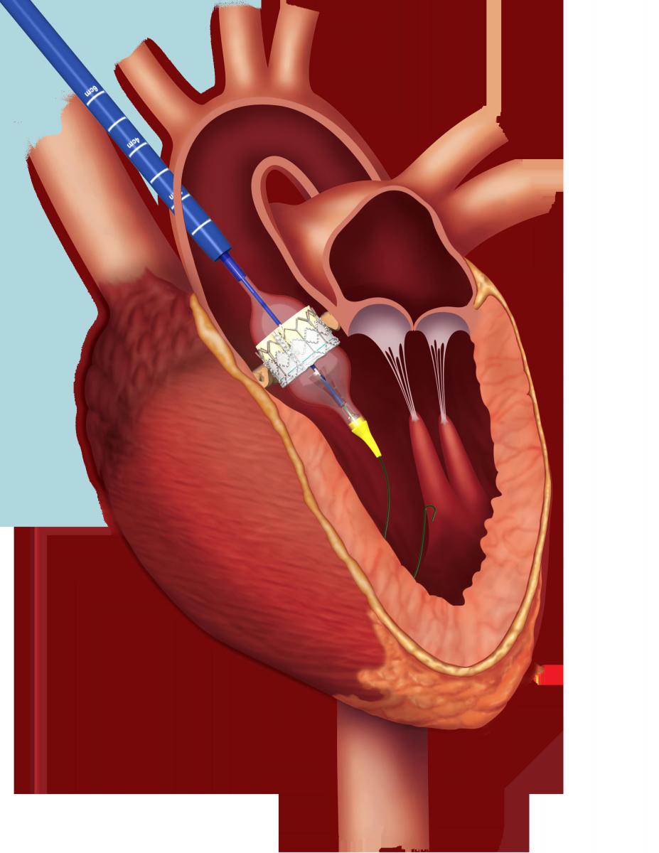 Trans Aortic Transcatheter Aortic Valve Replacement With Edwards Sapien 